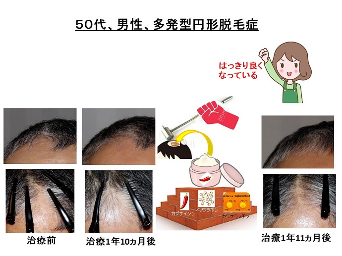 円形脱毛症　病院
